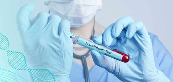 SingleB單抗發(fā)現(xiàn)技術攻克PCT檢測靈敏度難題 